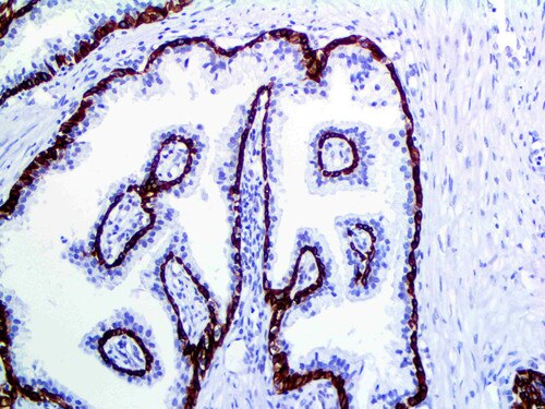 IHC of Cytokeratin 5 & 6 on an FFPE Prostate Tissue
